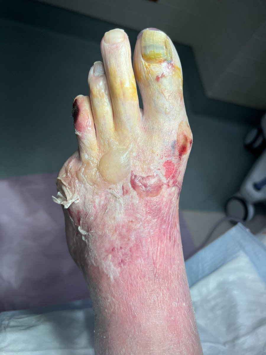FadiSaab17's tweet photo. Revascularization is only a step in the healing process for CLI patients.  It takes so many specialists to save a limb.  Join us @AMPSymposium to learn how all of us work together @EricSecemskyMD @monteromiguel @kmadass @ISETNews @_MCLIN_ @SriniTummala @t_intheleadcoat @Watts_IR @Colleen_Waters1 @SCAI @ACCinTouch @AmputationSuck @keithppereira @MacAnsari @HadyLichaaMD @JRUNMD @CLI_Global @DrBTKatzen