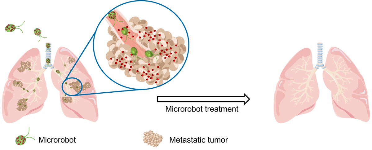 UCSD Engineering (@ucsdjacobs) on Twitter photo An experimental cancer treatment swims to the rescue to fight lung metastasis! <a href="/UCSanDiego/">UC San Diego</a> engineers created microrobots that swim throughout the lungs to deliver cancer-fighting medication directly to metastatic tumors, stopping their growth and spread. today.ucsd.edu/story/swimming⊠An experimental cancer treatment swims to the rescue to fight lung metastasis! <a href="/UCSanDiego/">UC San Diego</a> engineers created microrobots that swim throughout the lungs to deliver cancer-fighting medication directly to metastatic tumors, stopping their growth and spread. today.ucsd.edu/story/swimmingâŠ