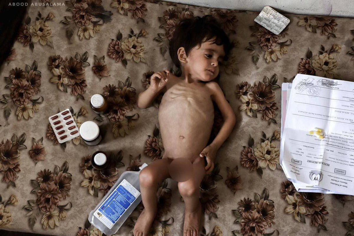 According to UNICEF, 3000 Palestinian children in Gaza are at risk of death due to severe malnutrition .
Included is the photo of the Palestinian child Amjad Qanou in North Gaza who is 3 years old and his weight is 5 kg only.