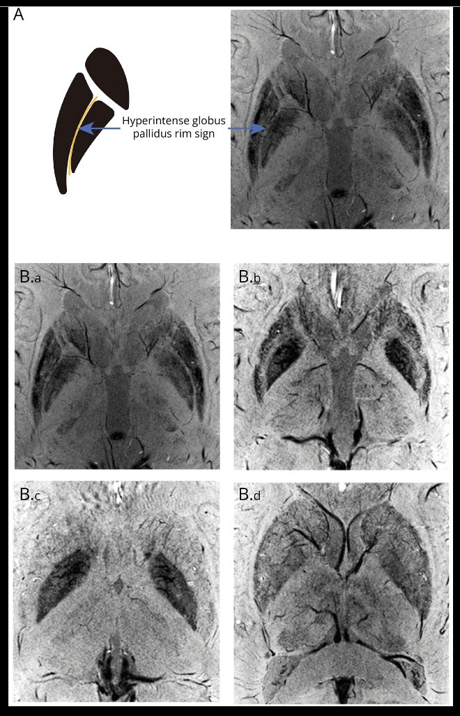 Have you heard of the 'hyperintense globus pallidus rim sign' which when it appears on brain MRI is suggestive of neurological Wilson's disease? Since it requires high field 7T imaging, it is likely you haven't seen it yet. Check out these beautiful pictures along w/ a nice