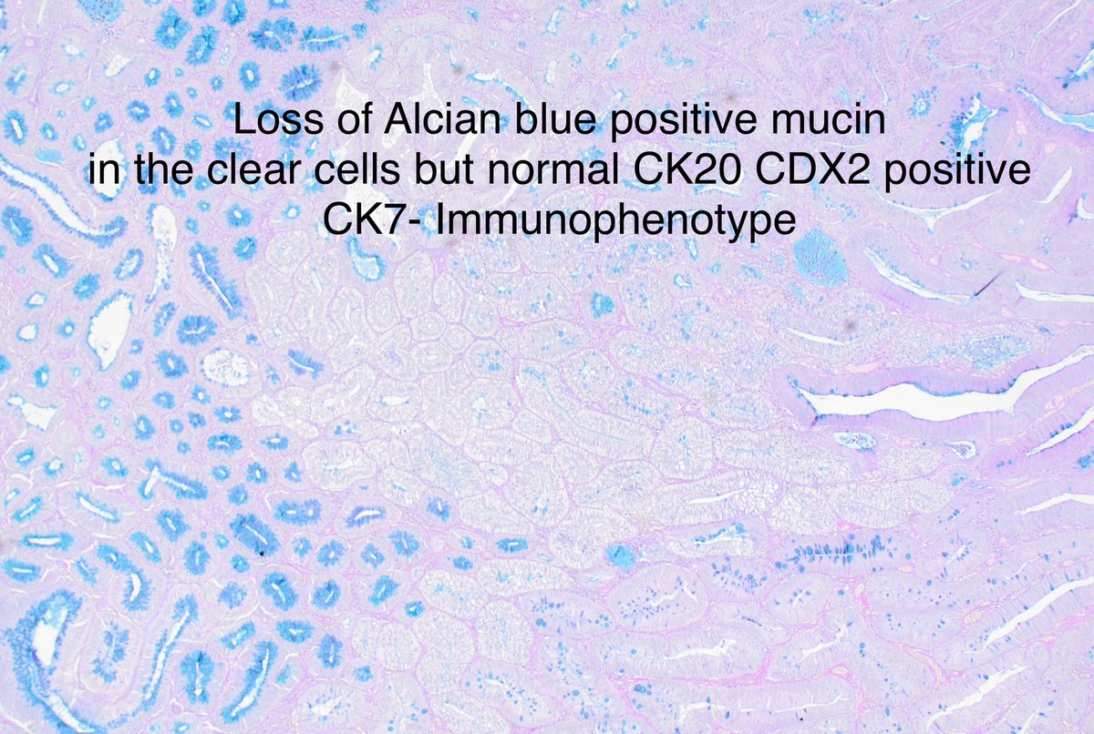 drtimbracey's tweet photo. Clear cell metaplasia in a sigmoid polyp from my colleague @edinpath. Resembles secretory endometrium and perhaps Sertoli cells! No clinical importance but pretty! Nice review by Dabir, van der Post &amp; Nagtegaal. Histopathology, 2021. 78: 348-357 #GIpath #Pathologists @pathkids https://t.co/X0Bajq9Jlr