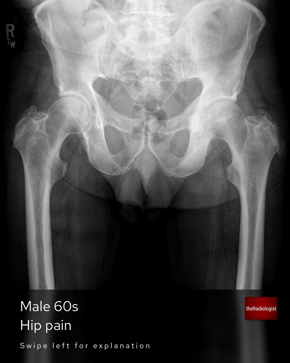 radiologistpage's tweet photo. Male in his 60s presents with hip pain https://t.co/L6I18lqhzT