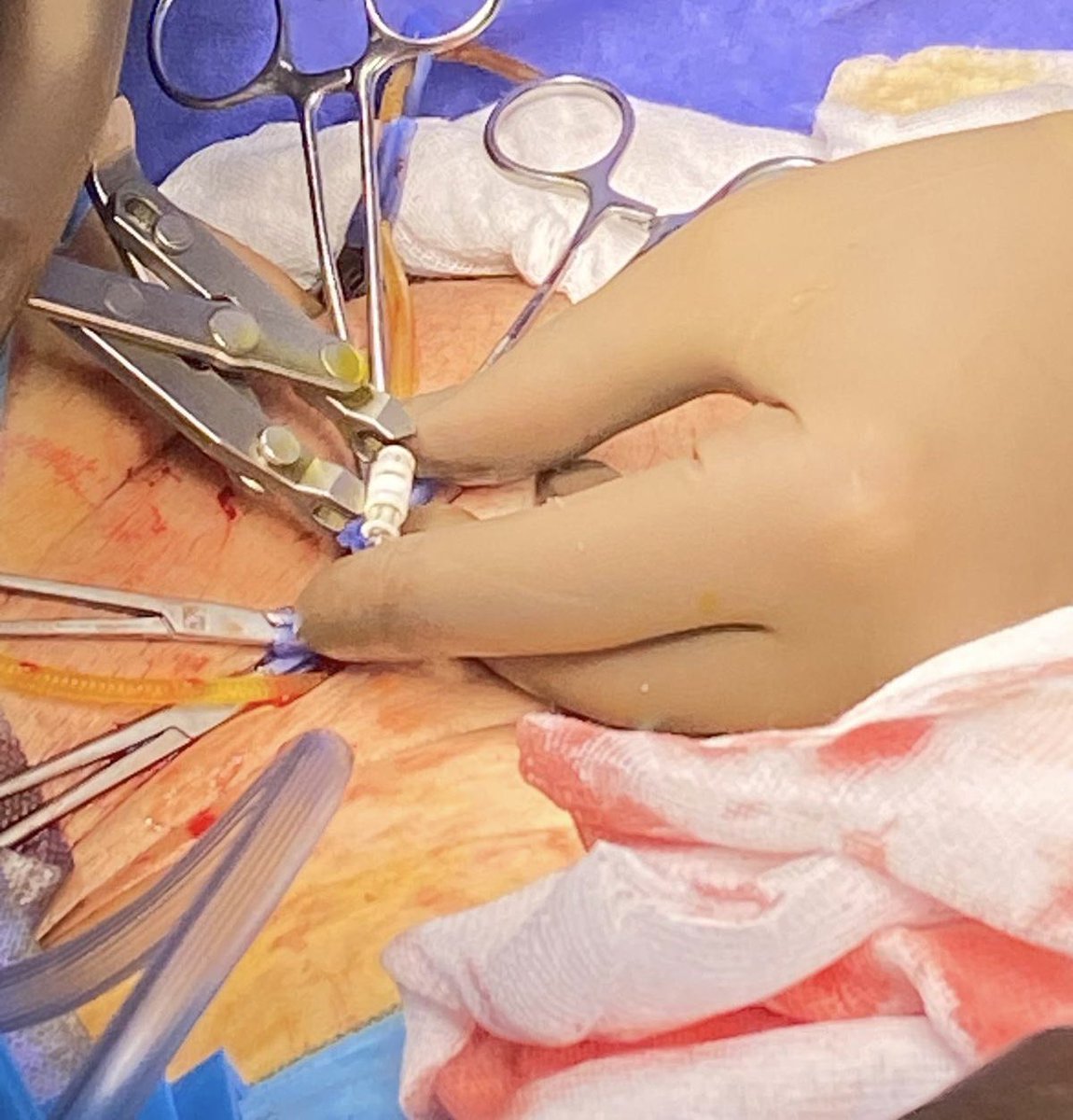 EmreHuri_MD's tweet photo. Artifical Urinary Sphincter Implantation in secondary case ! Fragile/ fibrotic bulbar urethra dissected through fine plans, no need transcorporeal route. Very good cuff size ( 4.5 cm) with excellent activation/deactivation trials. 

#hacettepe #incontinance #postprostatectomy https://t.co/iNMoJNaAu6