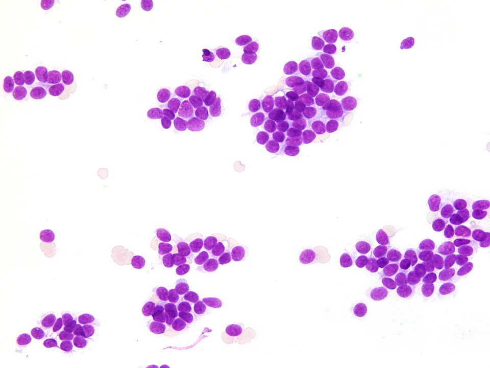 Alaa_Hrizat's tweet photo. Kidney FNA of a 1.5 cm incidental mass reveals tight clusters of round cells with scant cytoplasm and fine chromatin on the smear, and small primitive cells resembling early metanephric tubular differentiation on the cell block... Dx: Metanephric adenoma.     #cytology #cytopath https://t.co/CkGgDdnhcL