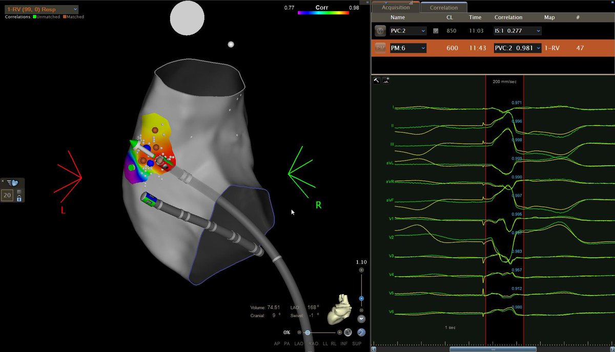 Very often in the EP room PVCs from RVOT are infrequent or even absent. Technology can help us achieve effectiveness and safety