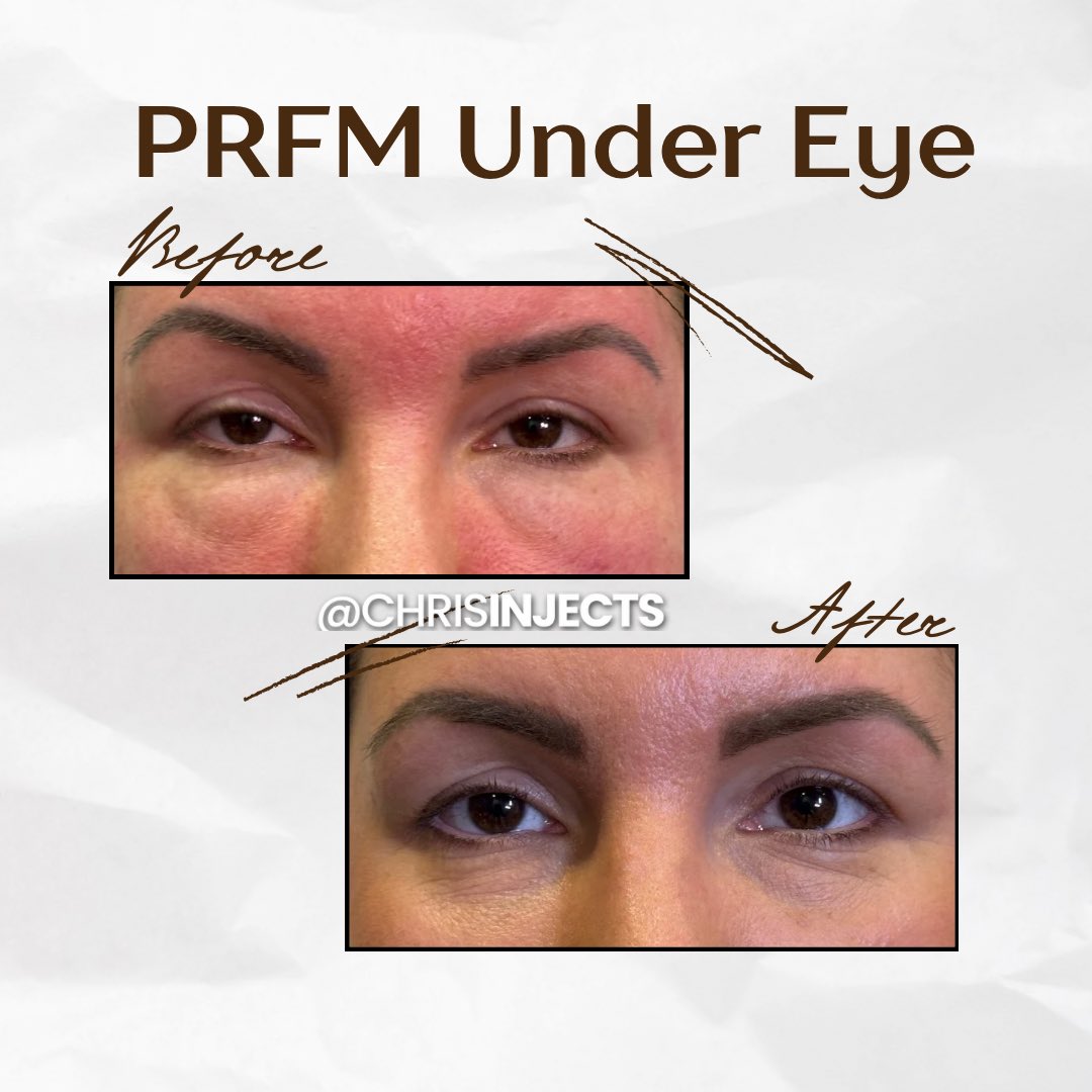 chrisinjects's tweet photo. ✨ Transform your look with PRFM Under Eye Rejuvenation with me! ✨
Results of my PRFM treatment. With this procedure we can start to target and repair this area together! 

🔹 Reduces dark circles
🔹 Fills in hollows
🔹 Helps stimulate Collagen/Elastin production 
🔹Rejuvenates https://t.co/dayPQsJJjq