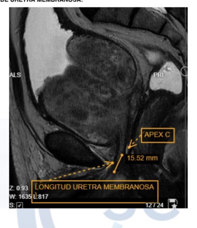 javhn16's tweet photo. #AEEP #BIPOLEP 380 grams, 
2-lobe, early release of the sphincter. 150 min of Enucleation and 120 of morcellation. irrigation 12 hours, hospital discharge after 24 hours.
@Moser_DanielC @HugoLopezRamos @endohugologo @trwherrmann @fgomsan @adolfoetienne @FullaJuan https://t.co/ISlr28lud8
