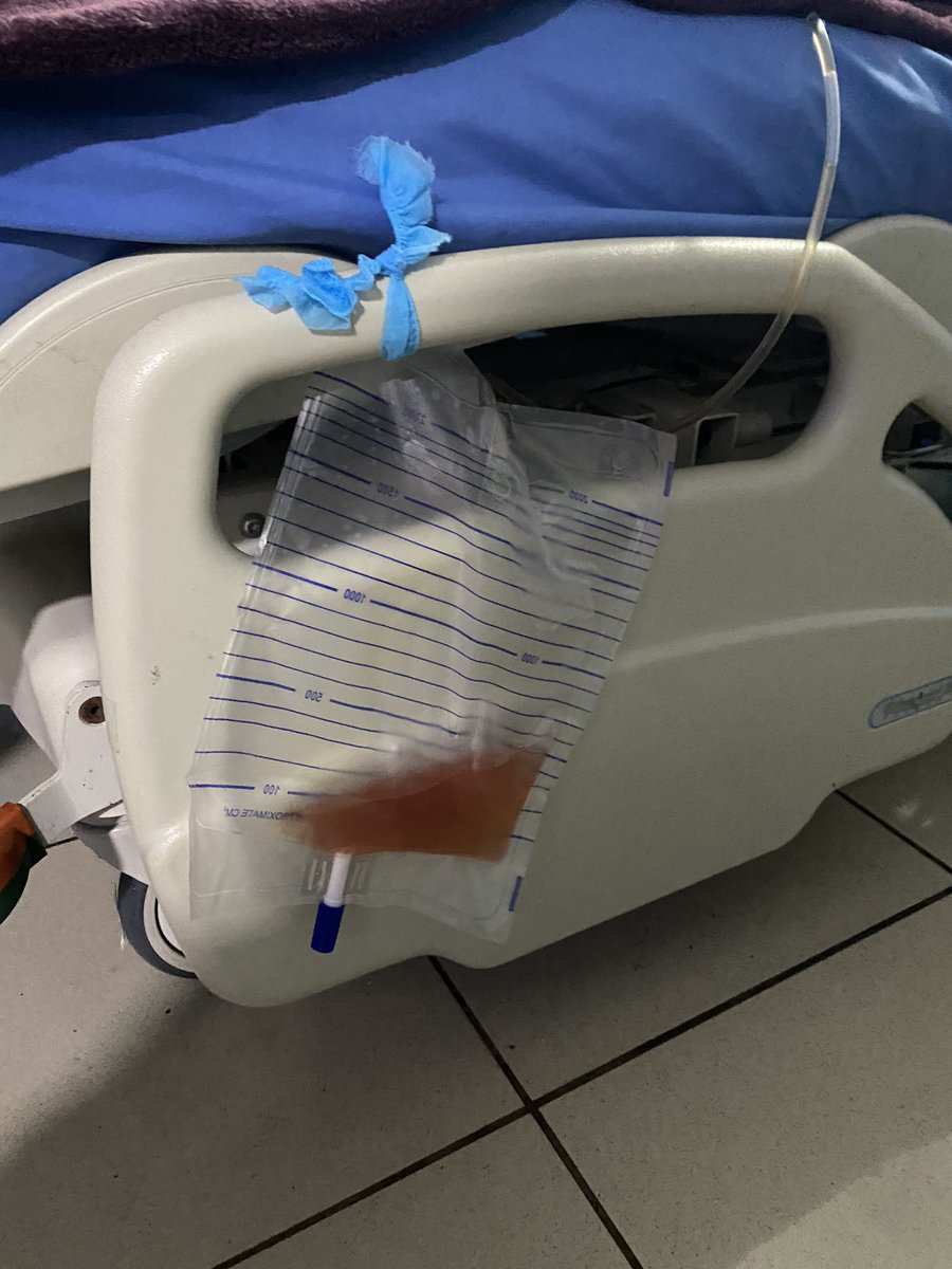 javhn16's tweet photo. #AEEP #BIPOLEP 380 grams, 
2-lobe, early release of the sphincter. 150 min of Enucleation and 120 of morcellation. irrigation 12 hours, hospital discharge after 24 hours.
@Moser_DanielC @HugoLopezRamos @endohugologo @trwherrmann @fgomsan @adolfoetienne @FullaJuan https://t.co/ISlr28lud8
