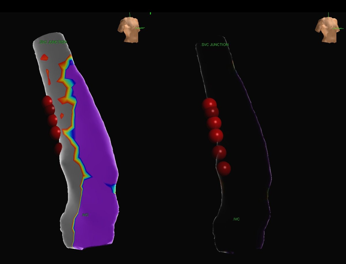 Zain Khalpey, MD, PhD, FACS (@zainkhalpey) on Twitter photo World First Robotic IST Ablation: Next Level
Yesterday, we successfully performed a groundbreaking procedure - the world's first robotic Inappropriate Sinus Tachycardia (IST) ablation. IST is a clinical syndrome that causes an inexplicably high resting heart rate (>100 bpm), World First Robotic IST Ablation: Next Level
Yesterday, we successfully performed a groundbreaking procedure - the world's first robotic Inappropriate Sinus Tachycardia (IST) ablation. IST is a clinical syndrome that causes an inexplicably high resting heart rate (>100 bpm),