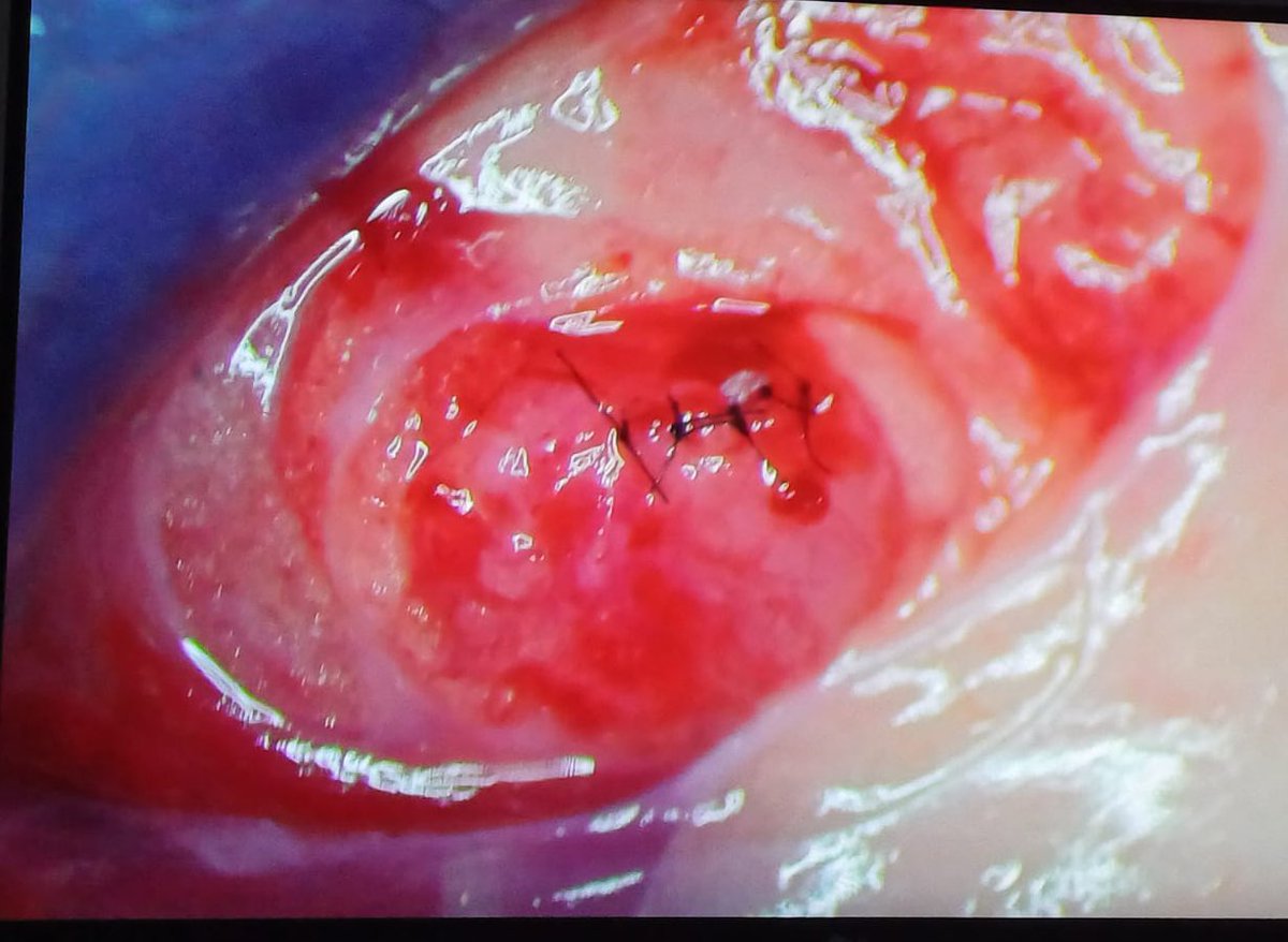 DrCesarMayorga's tweet photo. Microsurgical removal of a ureteral stone in a 3 YO cat with pyonephrosis. Surprisingly effective. Full recover within few days. #nefrovetcolombia https://t.co/880rAoJk2q