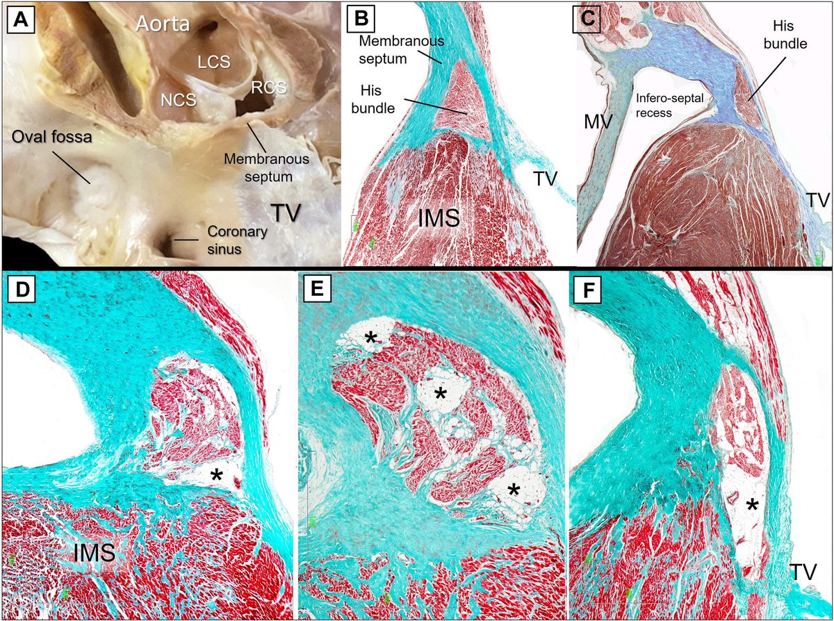 Dr. José Ángel Cabrera (@jacabreracardio) on Twitter photo Cocaine and Cardiac Conduction System: A Comprehensive Morphological Comparison Between Young Cocaine Users & Nonconsumers eur02.safelinks.protection.outlook.com/?url=https%3A%…
<a href="/JACCJournals/">JACC Journals</a> #JACCEP <a href="/shivkumarmd/">Kalyanam Shivkumar MD PhD</a>
The bundle of His after cocaine abuse (19-29 y). The myocytes are replaced by adipose tissue (*) Cocaine and Cardiac Conduction System: A Comprehensive Morphological Comparison Between Young Cocaine Users & Nonconsumers eur02.safelinks.protection.outlook.com/?url=https%3A%…
<a href="/JACCJournals/">JACC Journals</a> #JACCEP <a href="/shivkumarmd/">Kalyanam Shivkumar MD PhD</a>
The bundle of His after cocaine abuse (19-29 y). The myocytes are replaced by adipose tissue (*)