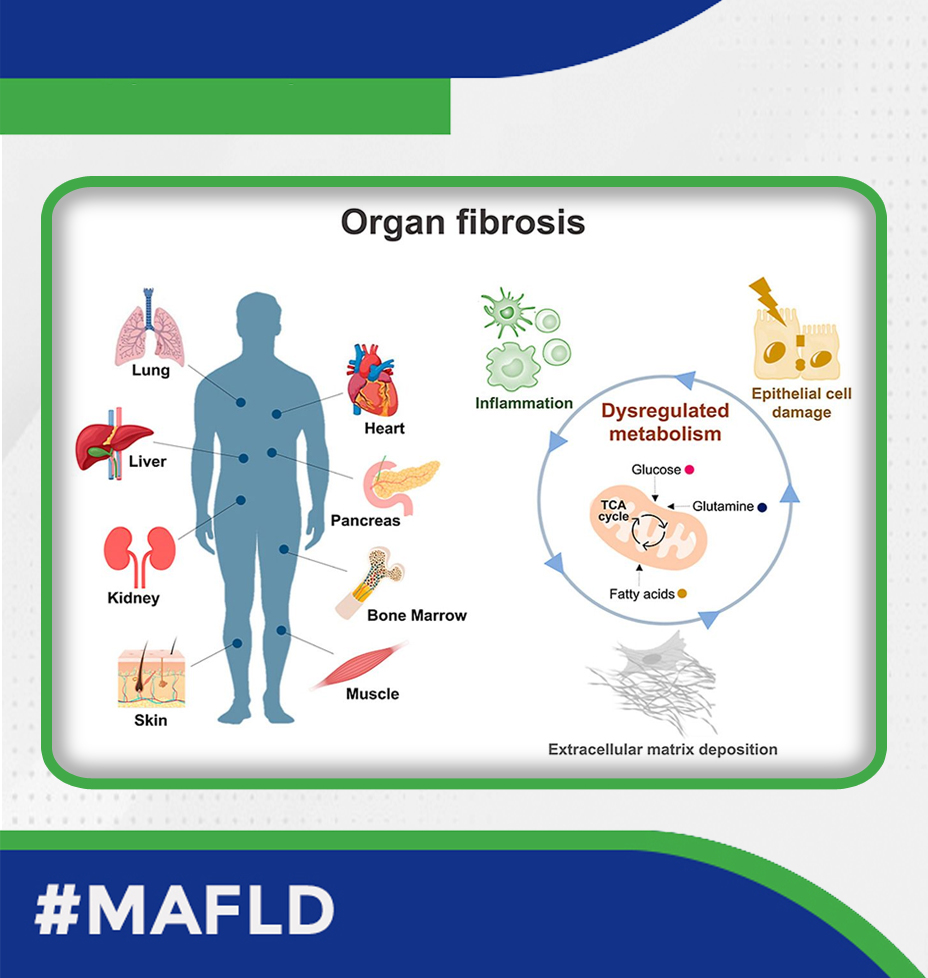 🔔Metabolism has emerged as a major driver of fibrotic diseases and provides new therapeutic options‼️