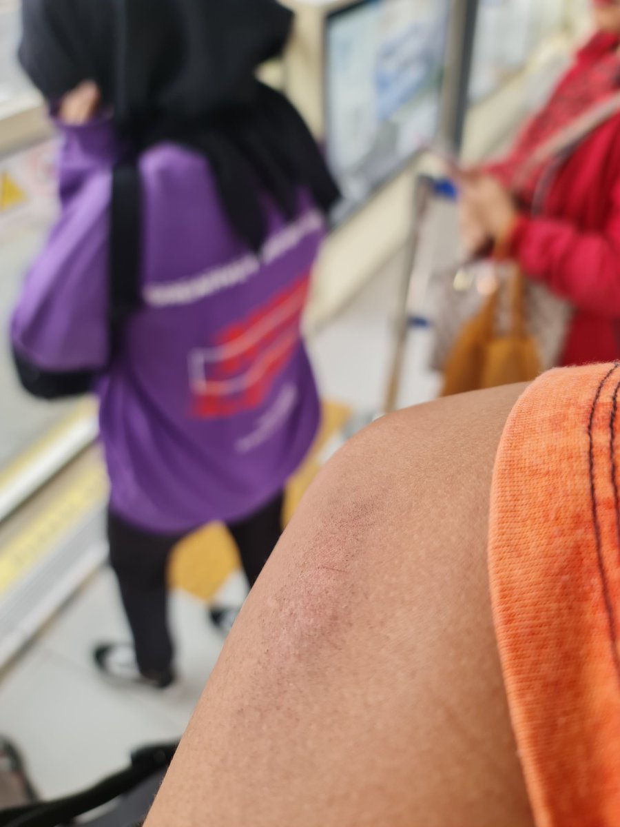 Deny_saputraaa's tweet photo. @PT_Transjakarta baru sadar tangan sampe memar https://t.co/5pQJfJM8Oz
