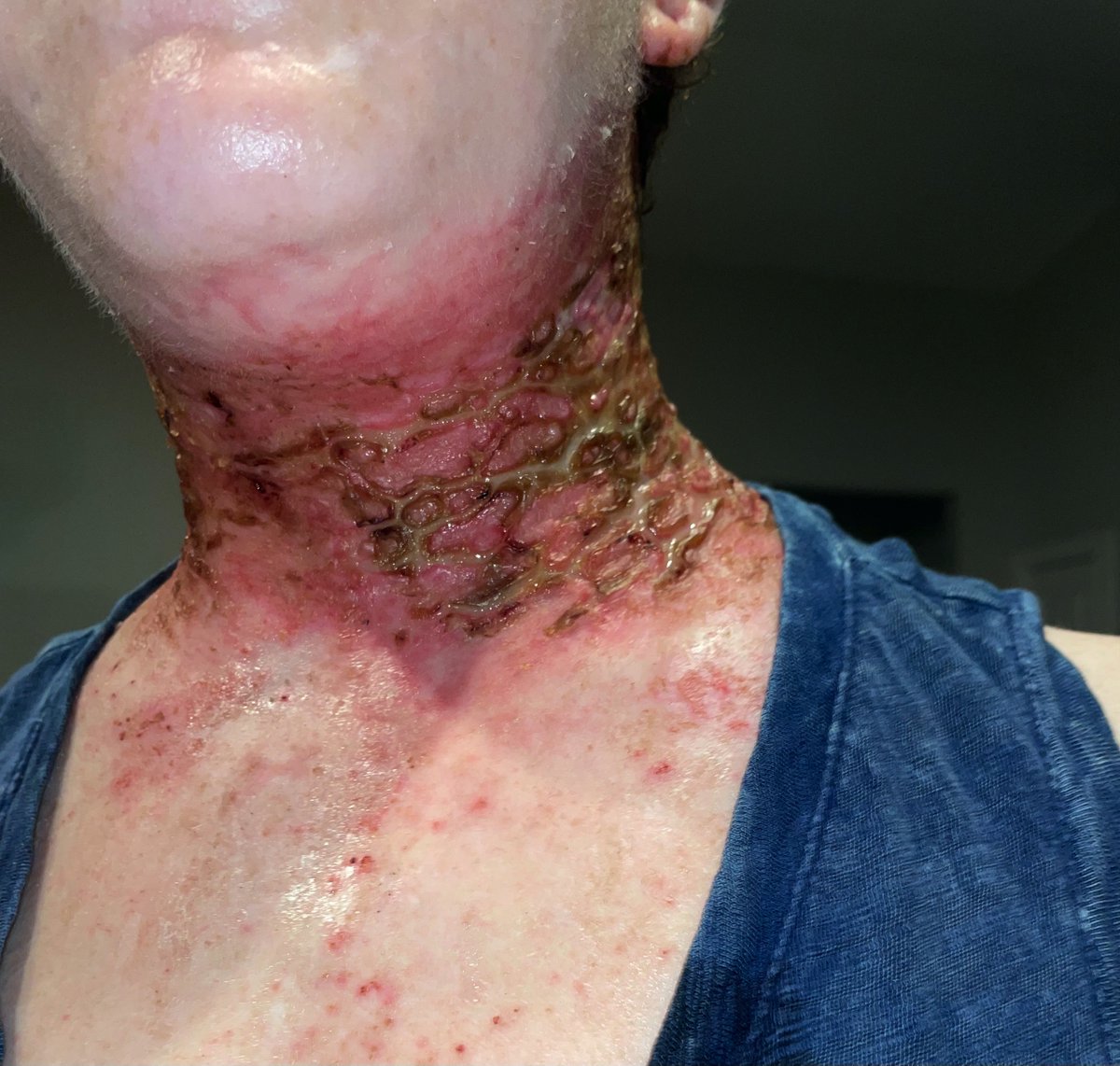 CailinElissa's tweet photo. Based on the living hell that has become my life thanks to societal stigma and systemic bias in our healthcare system, facilitated by the Health Information Exchange (aka HIE or in RI, CurrentCare), I’d like to accuse the aforementioned of encouraging both infectious disease and substance abuse to thrive in our society. I speak from personal experience that has left me extremely unwell and wracked with fear in the dangerous, untenable, unacceptable position in which they have left me: like something out of a horror movie, I can feel this thing writhing within my head, neck, and back. I have been BEGGING for help for over a year, expressing my concern about relapse after 5 years in recovery, but all I’ve gotten in response was gaslit, traumatized, neglected, drug tested, mocked, mortified, patronized, and rejected as either delusional or dishonest by Brown University physicians and other, unaffiliated clinicians alike. I've had doctors laugh in my face, make false, unfounded accusations, and taunt me with rude remarks. They’d ask me what I hoped to gain by being there, passive aggressively as if the gaping, open wound festering around my neck and oozing green puss was merely a paper cut.

Despite repeatedly passing their UA’s, they kept giving me these drug tests instead of the diagnostic testing I had been begging from the jump. They wrote me off as a hysterical girl while the still-undiagnosed problem (aka a horrifying infection, presumably, that has destroyed my scalp, cost me the long locks of curly hair that was once integral to my identity, and the epidermis on my head) was not easily observed, hidden beneath my thick mane. They tortured me for months on end while I endured excruciating pain and abject terror on a constant basis before reluctantly and angrily swabbing my wound once it finally began to creep down my neck from my scalp in the form of a rash. Meanwhile, I remained helpless to address the red-blooded bugs and even creepier things my infested scalp produced after having finally buzzed off my long locks in desperation, an act which they perceived as proof of insanity.

Their perspective stunted by the clinical research gap that plagues American medicine, they finally carried out this minimal and basic diagnostic test with disdain: exaggerated sighs, eye-rolls, and sneers, as if I was wasting their “valuable” time. This is why it took three months of constant visits to specialists, ER's, and a primary care doctor who turned out to be actively perpetuating my neglect (and who is no longer thusly employed at the same office where I saw her), to finally get diagnosed with a staph infection, which emerged, among other afflictions, secondary to my main problem.

I was admitted to hospitals four times over with a skyrocketing white blood cell count of 30,000, hooked up to IV's and pumped with antibiotics for days on end, only to find, time after time, that the issue was not resolved. No one was concerned with finding a definitive explanation or solution, still convinced that I had somehow manifested this myself in a devious ploy to acquire drugs. Instead, they continued to mock my pain, for which I have always had a notoriously high tolerance, and ignore the bulk of my symptoms—the most alarming ones in particular—as invented or imagined regardless of the overwhelming wealth of hard evidence and photos I presented to the contrary, all of which they barely glanced at before dismissing them as irrelevant. Unwilling to perform their own investigation to see for themselves, I was left with a severe problem that most every doctor willfully ignored, uninterested in obtaining facts or evidence as they were. I remained virtually homebound for months, plagued by feverish hallucinations and paranoia in addition to my physical discomfort, unwilling to venture out in public with the masses gawking at my green neck.

I hope my fellow persons in recovery will learn from my mistake and forget the dangerously bad advice we all receive to be honest with medical providers about our past before their own naive disclosure is used against them with impunity and without shame in the aggressive and longterm gaslighting of their healthcare under the most dire of circumstances. Moreover, I know my voice is of no consequence, that it will be ignored once more and drowned out by all the noise and mainstream chatter that defines social media, but I’m going to put it out there anyway via every outlet I can find until people in my demographic receive the same care and attention by the medical community as anyone else, the same respect as they deserve and the treatment they are entitled to as American citizens.

Quite frankly, the status quo at present is offensive and unacceptable. Furthermore, it leads struggling individuals like myself to overdose in despair, years of sobriety tragically and needlessly upended by 8 months of medical gaslighting and mistreatment at a time of genuine need. The truth is that after all this time, I’m exhausted, and I am sincerely uncertain if I can take much more of this: my whole life on hold while an unidentified, idiopathic infection has its way with me, and no hope in sight to light my way in this unending darkness...

So, I'm going to post my rant far and wide on this platform and in regulatory complaint portals whether anyone wants to hear it or not. Unfortunately for me and the providers responsible for my continued suffering, simply ignoring the plethora of horrifying medical evidence and my extremely alarming pathology does not make them cease to exist. Therefore, should this approach fail me, I intend to shave my head—down to the skin—on film, then saturate social media with the video.

I have seen the snake-like and criss-cross imprint it leaves on the hydrogen peroxide-soaked pads I press against my sizzling head. I can feel it squeezing my throat and moving deep within my back. I think it might even have a grip on my heart… and I promise all those providers, unhelpful politicians, and the public at large that what I uncover and the lawsuit that ensues will at long last teach those guilty of my mistreatment and their complacent cohorts exactly where they stand relative to this insignificant junky (if this “thing” doesn’t rip through my scalp itself or just kill me in the meantime—a consequence threatened by an intensifying pressure in my head and my torso that torments me at present). My fear will become theirs when I knock them down here to the ground where they belong by exposing the deeply disturbing state of my scalp and the advanced affliction concealed within it, however long it takes. I will not stop until I achieve something like justice for this egregious betrayal and the many others just like it that society ignores, even if I have to take one for the team. I will do it gladly out of principle and without fear. You see, my argument is grounded in fact, and I have no doubts, but they and I well know just how shaky is the ground they stand upon by contrast, even if their dissonance deludes them.

Is arrogance enough to protect their reputations in a notoriously disparate system? Perhaps, but my intellect and my will have not failed me yet, and I’ll be damned if they’re going to start now. So, if I survive whatever new horror is taking place and moving within me right now, it’s only a matter of time before these providers’ hubris, their hate, and their shaky assumptions cease to sustain them… and they should be worried, because they’ve never seen an unrelenting fury quite like mine. Let’s hope they don’t have to.

**This article provides an excellent description of the joy and amusement that ER staff get from using their  alert system to gaslight patients with a history of substance abuse (active users and those in recovery, with my own recent and horrific experience serving as proof of the latter, because I assure you, no amount of clean UA's could satisfy this hateful and arrogant bunch of prigs and their terrifyingly dangerous, nomothetic hive mind that malfunctions in the face of novelty):
https://t.co/eaVDckx2hO