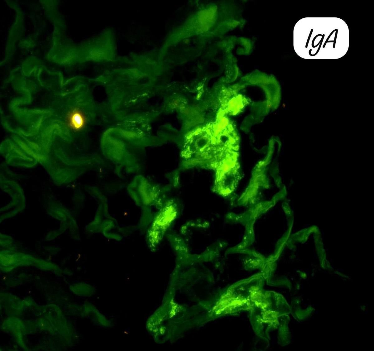 RenalPathLabs's tweet photo. Every day there is something new to learn for PGs. Making it simple!
Native Bx, Diabetic patient.
With these features what would you say??
#RenalPath #RenalPathology #AskRenal #AskRenalPath #RenalPathCases #Nephtwitter #PathTwitter #RenalPathLabsIndia #PoojaMaheshwari https://t.co/EEIPdxhVQQ