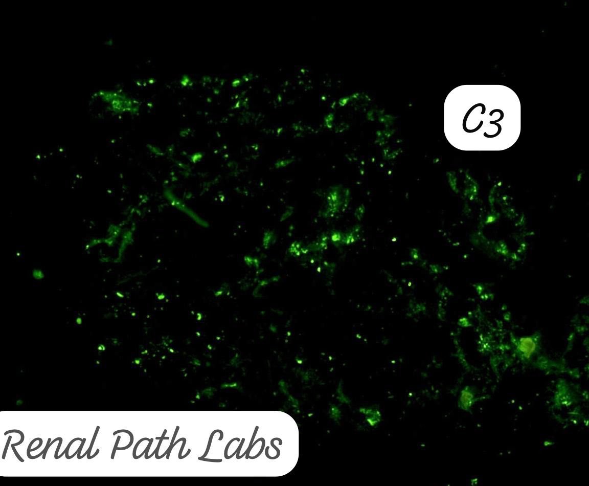 RenalPathLabs's tweet photo. Every day there is something new to learn for PGs. Making it simple!
Native Bx, Diabetic patient.
With these features what would you say??
#RenalPath #RenalPathology #AskRenal #AskRenalPath #RenalPathCases #Nephtwitter #PathTwitter #RenalPathLabsIndia #PoojaMaheshwari https://t.co/EEIPdxhVQQ