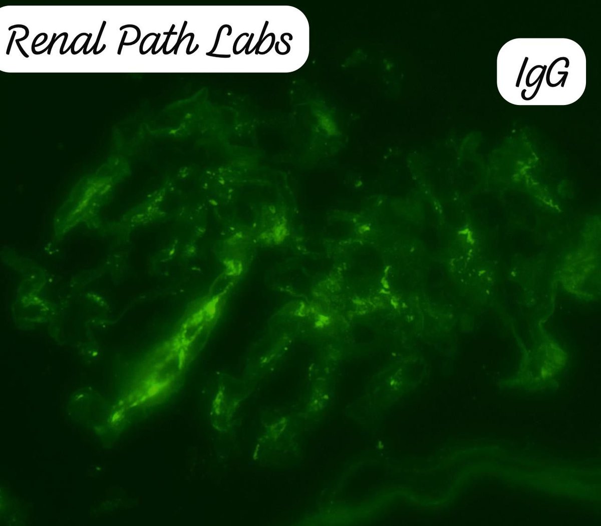 RenalPathLabs's tweet photo. Every day there is something new to learn for PGs. Making it simple!
Native Bx, Diabetic patient.
With these features what would you say??
#RenalPath #RenalPathology #AskRenal #AskRenalPath #RenalPathCases #Nephtwitter #PathTwitter #RenalPathLabsIndia #PoojaMaheshwari https://t.co/EEIPdxhVQQ