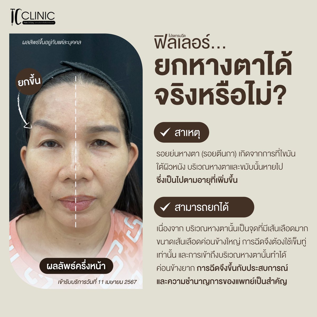tc_yst's tweet photo. 🔍 โปรแกรมฉีดฟิลเลอร์ยกหางตาได้จริงหรือไม่? เรามีคำตอบให้คุณ!
"อยากปรับรูปหน้าโดยไม่ต้องผ่าตัด ไว้ใจเรา TC Clinic"

#ฟิลเลอร์ #filler #tcclinic #ยกหางตา #foxylift https://t.co/EcPv9JxilD