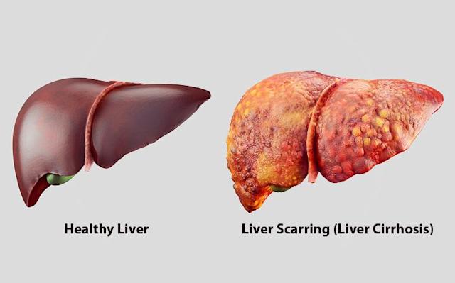 FirstDoctor's tweet image. Stop normalizing alcohol consumption. Alcohol can cause a type of serious liver disease known as cirrhosis, and you may not know about it until it is too late. Save your liver.