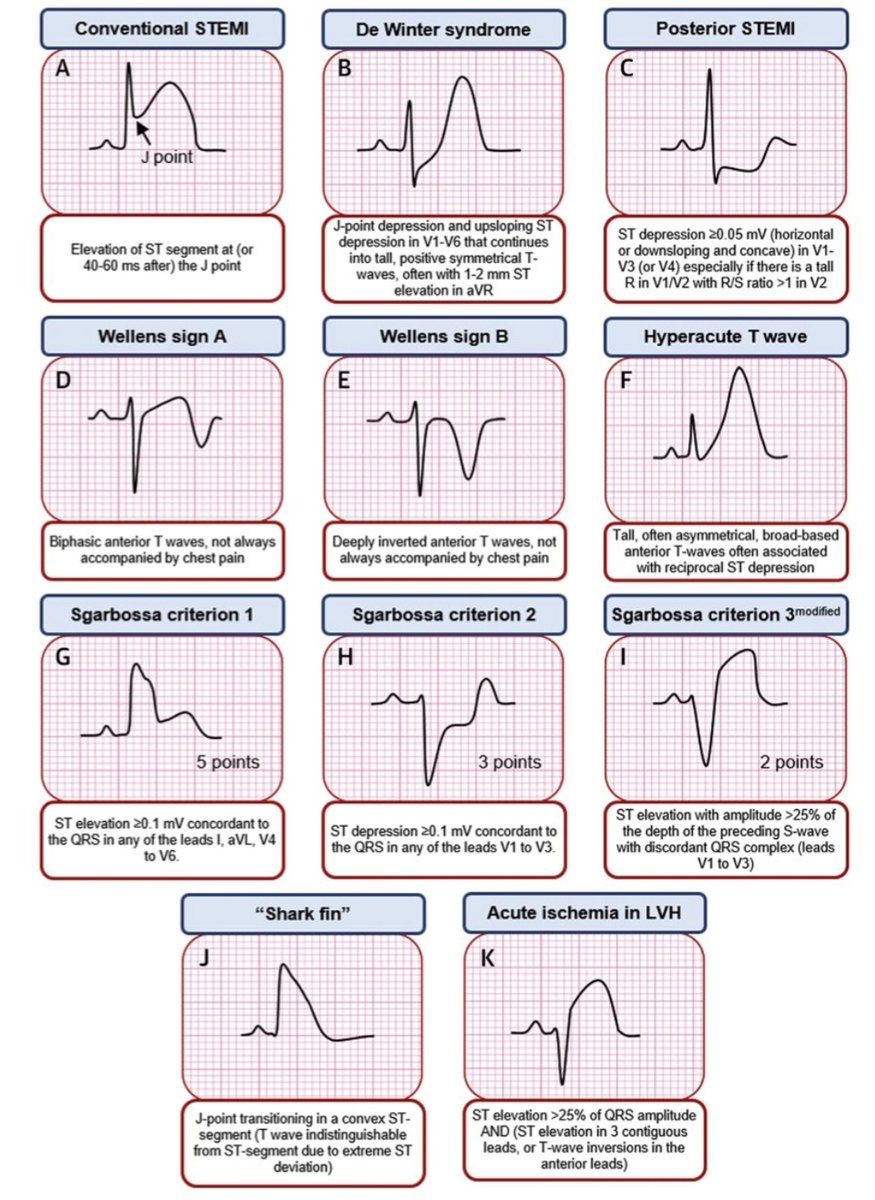 High Risk ECG Patterns:
