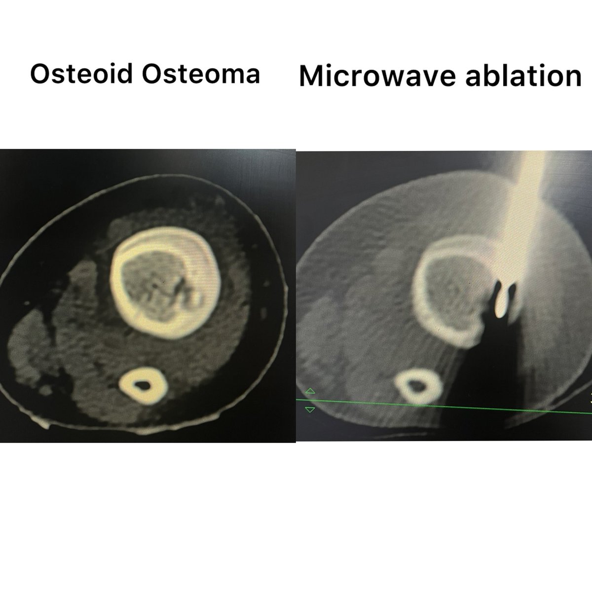 Pulkit Rangarh (@pulkitrangarh) on Twitter photo #ablation osteoid osteoma in Pediatric patient.
Minimally invasive , highly effective mode of treatment. Complete pain free in 2 days.
#interventionalradiology #interventionaloncology <a href="/AIMSFaridabad/">Asian Hospital</a> <a href="/ISVIRIndia/">ISVIR India</a> #ablation osteoid osteoma in Pediatric patient.
Minimally invasive , highly effective mode of treatment. Complete pain free in 2 days.
#interventionalradiology #interventionaloncology <a href="/AIMSFaridabad/">Asian Hospital</a> <a href="/ISVIRIndia/">ISVIR India</a>