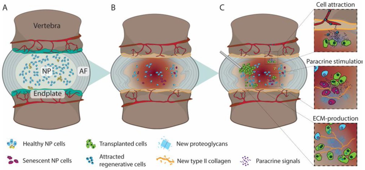 #mdpiMedicina #TopCitedPaper   

📢Clinical Development of Regenerative #Medicine Targeted for #Intervertebral #Disc #Disease

✍️By Daisuke Sakai et al.
👉mdpi.com/1648-9144/58/2…