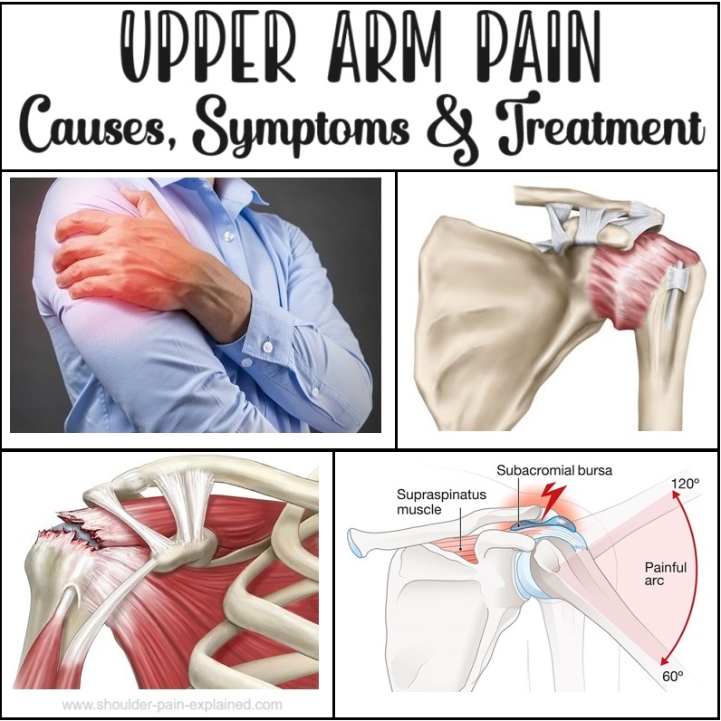 ShoulderPainExp's tweet photo. Upper Arm Pain? Find out about the different causes of pain in the upper arm and the best ways to treat them https://t.co/McX4BdMCgQ https://t.co/z1kkiy8SYP