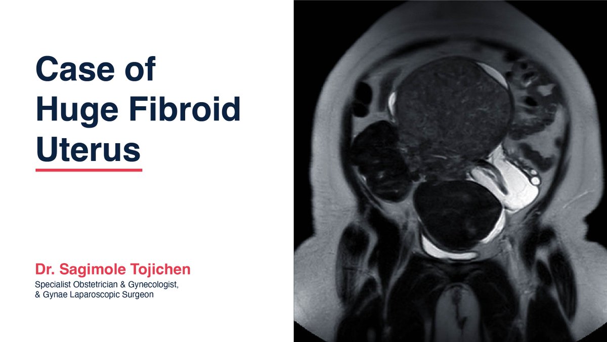 Witness the incredible case of a huge fibroid uterus successfully managed by Medeor Hospital Dubai! A 38-year-old patient underwent a remarkable surgery to remove multiple large fibroids, thanks to the expertise of our dedicated team.

Full story here: ow.ly/BA4550ShQCR
