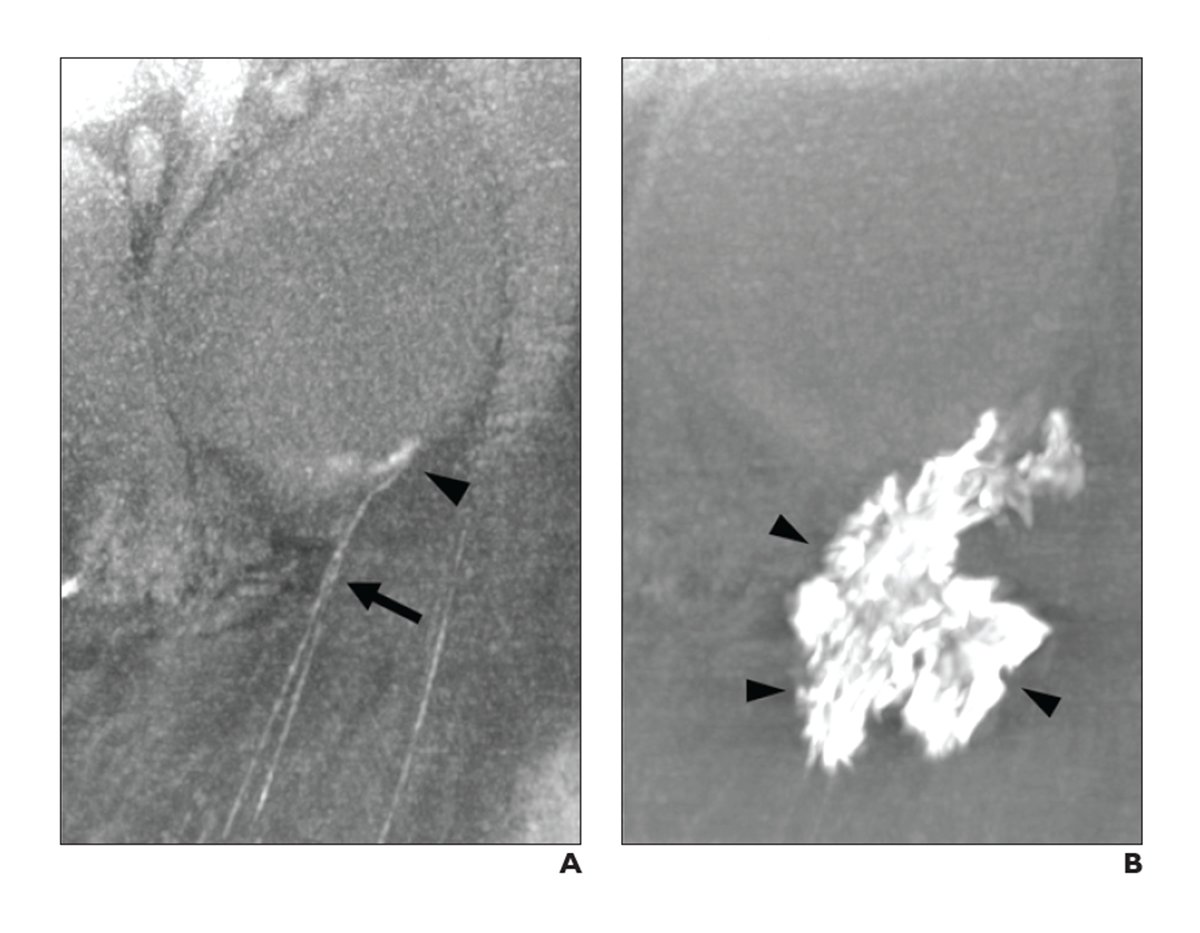 AJR_Radiology's tweet photo. This modification of the transpedal lymphangiography technique shortens and simplifies the procedure, eliminating the need for surgical exposure of the lymphatic vessel. https://t.co/uihP8d1Uwk https://t.co/ix4kFZOq8C