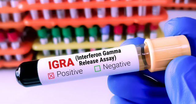 Dt_Aerzteblatt's tweet image. Jak-Inhibitor Ruxolitinib bei autoimmunem polyendokrinem Syndrom Typ 1 wirksam:  Bethesda/Maryland – US-Mediziner haben herausgefunden, dass es beim autoimmunen polyendokrinen Syndrom vom Typ 1 zu einer vermehrten Produktion von… dlvr.it/T8DJ9v #APECED #NEJM