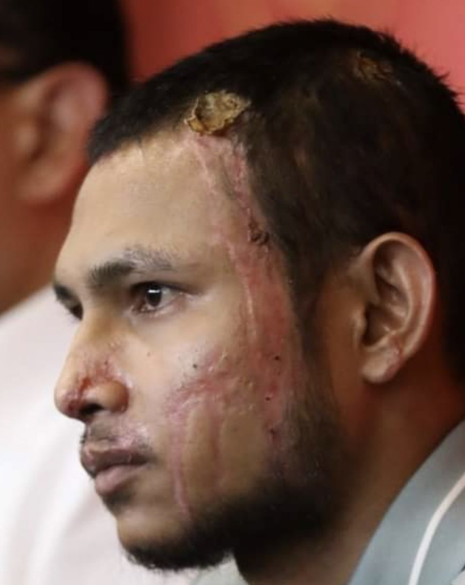 Faisal Halim wears his Battle Scars like a Warrior.Proud n Strong.Bangkit n Semangat.Anak Jantan

Sementara si pelaku bersembunyi. Coward.Big Bully. 1Malaysia Sumpah korang

Kifarah is real. Semoga Allah dah balas. Antara korang sedar atau tidak je

Aamiin.