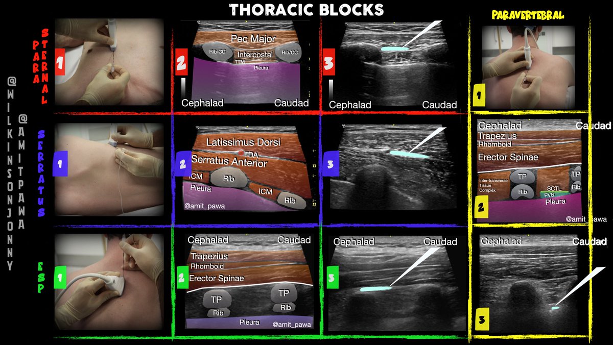 Jonny Wilkinson (@wilkinsonjonny) on Twitter photo Live on stage at #SOA24, ‘Blocks for ITU’! 💉 <a href="/RegionalAnaesUK/">RA-UK</a> <a href="/ICS_updates/">Intensive Care Society 💙</a>
Wed Jun 19th 11:30-12:45 #FOAMed #POCUS #FOAMcc
Programme: ics.ac.uk/soa/programme.…
And the first taster infographic by myself and <a href="/amit_pawa/">Dr Amit Pawa💉🎙️</a> 👇👇
Get it —> criticalcarenorthampton.com/blockographics/ Live on stage at #SOA24, ‘Blocks for ITU’! 💉 <a href="/RegionalAnaesUK/">RA-UK</a> <a href="/ICS_updates/">Intensive Care Society 💙</a>
Wed Jun 19th 11:30-12:45 #FOAMed #POCUS #FOAMcc
Programme: ics.ac.uk/soa/programme.…
And the first taster infographic by myself and <a href="/amit_pawa/">Dr Amit Pawa💉🎙️</a> 👇👇
Get it —> criticalcarenorthampton.com/blockographics/
