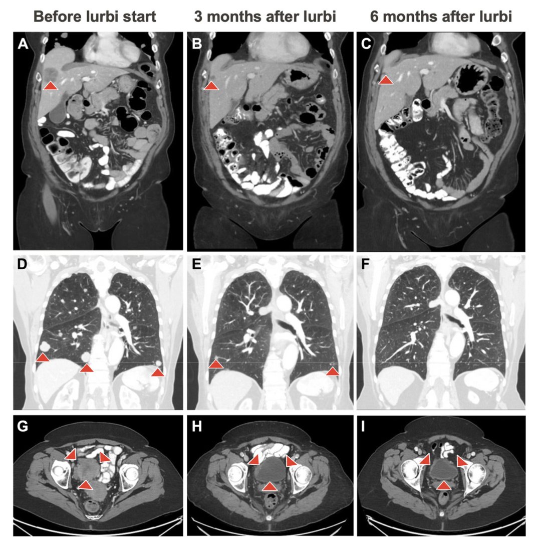 Mohammad Jad Moussa, MD, MSc (@mjmoussa_) on Twitter photo ⚡️NOW IN PRESS: Durable Objective Response to Lurbinectedin in Small Cell Bladder Cancer with TP53 Mutation: A Molecular-Directed Strategy🧬 #PrecisionOncology
👉GU ASCO #GU24: Original multi-institutional series on off-label use of lurbi in SCBC-enriched GU cohorts <a href="/OAlhalabiMD/">Omar Alhalabi, MD</a> ⚡️NOW IN PRESS: Durable Objective Response to Lurbinectedin in Small Cell Bladder Cancer with TP53 Mutation: A Molecular-Directed Strategy🧬 #PrecisionOncology
👉GU ASCO #GU24: Original multi-institutional series on off-label use of lurbi in SCBC-enriched GU cohorts <a href="/OAlhalabiMD/">Omar Alhalabi, MD</a>