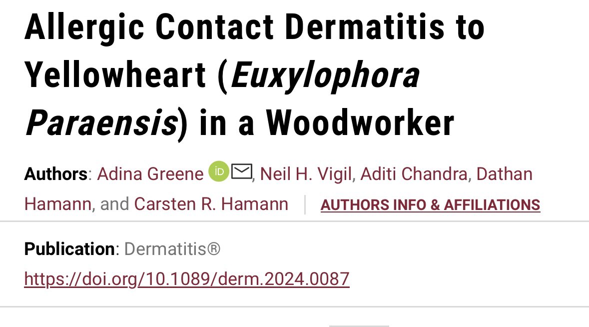Adina Greene (@adinargreene) on Twitter photo Another awesome update that our case report on ACD in a Woodworker that I presented in March of 2024 at ACDS was recently published in <a href="/DermatitisJrnl/">Dermatitis Journal</a>! Love seeing these projects come to fruition #dermtwitter #medtwitter Another awesome update that our case report on ACD in a Woodworker that I presented in March of 2024 at ACDS was recently published in <a href="/DermatitisJrnl/">Dermatitis Journal</a>! Love seeing these projects come to fruition #dermtwitter #medtwitter