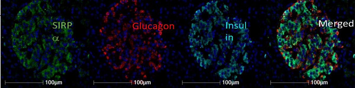 Inhibition of HDAC6 could help prevent β-cell death in t1 diabetes. Drugs which target HDAC6 are being developed, raising hopes that they could be repurposed for testing in t1.
<a href="/ngmorgan1/">Noel G Morgan</a> <a href="/afilesnice/">AFI LESLIE</a> <a href="/ibex01/">Islet Biology Exeter</a> <a href="/Exeter_Diabetes/">ExeterDiabetes</a> <a href="/SarahIBEx/">Sarah Richardson</a> <a href="/ADA_Pubs/">ADA Professional Publications</a>
Read Here➡️doi.org/10.2337/db24-0…