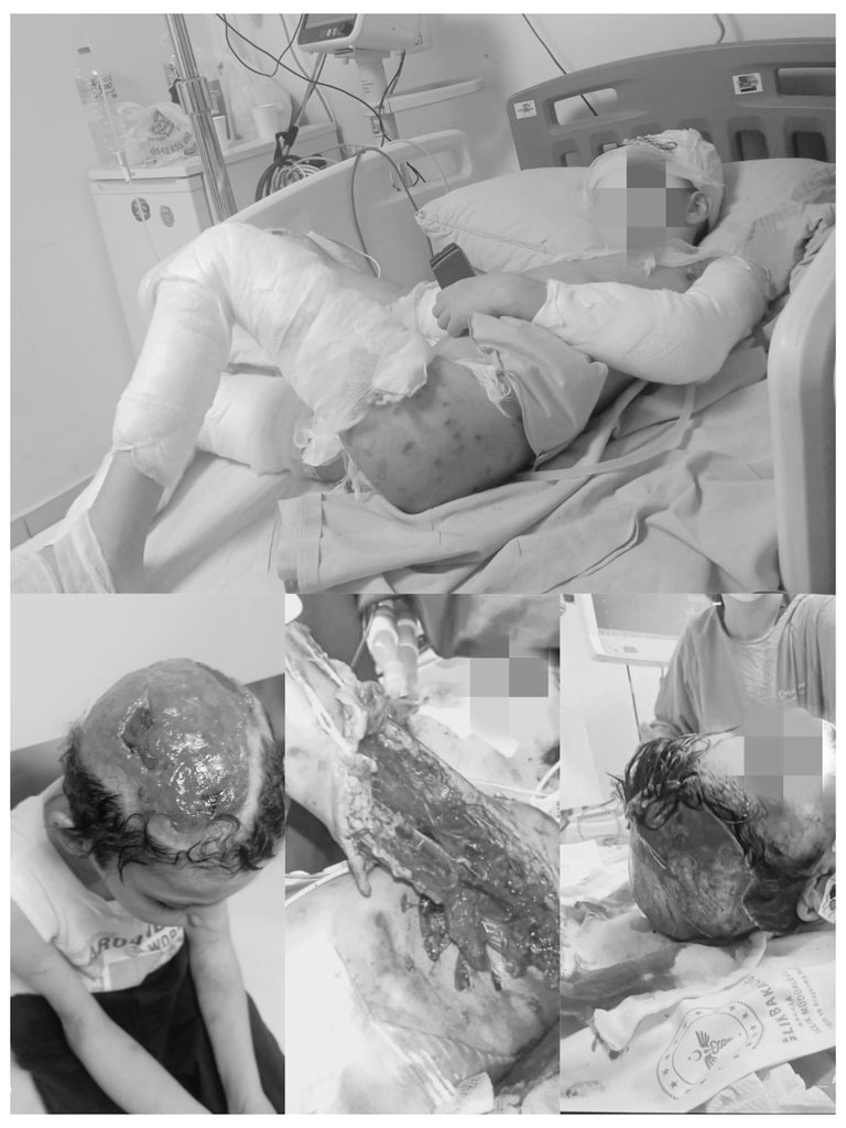 insanhaklarim's tweet image. #Başıboşköpekler tarafından parçalanmış, 14 ameliyat olmuş çocuğu için &quot;keşke ölseydi de bu kadar acı çekmeseydi&quot; diyen bir babayı biz çok iyi anlıyoruz da, #Katil5199 konusunda köpekleri kollayan, ama onlar da can, üçüncü bir yol olmalı diyenlerin anlamasını bek-le-mi-yo-ruz.