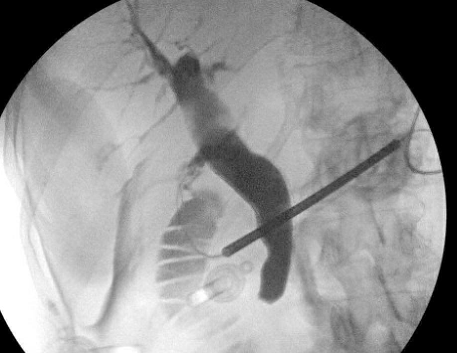 EUSandEndoscopy's tweet photo. Marked #BileDuctDilation pre #LapChole on US, CT, & MRCP but GI not consulted until after #IOC contrast failed to pass into duodenum. Papilla in diverticulum & small pigmented stone extracted. Type 1c #Choledochocyst or transient CBD dilation d/t obstruction? https://t.co/WFXt9rnHwD