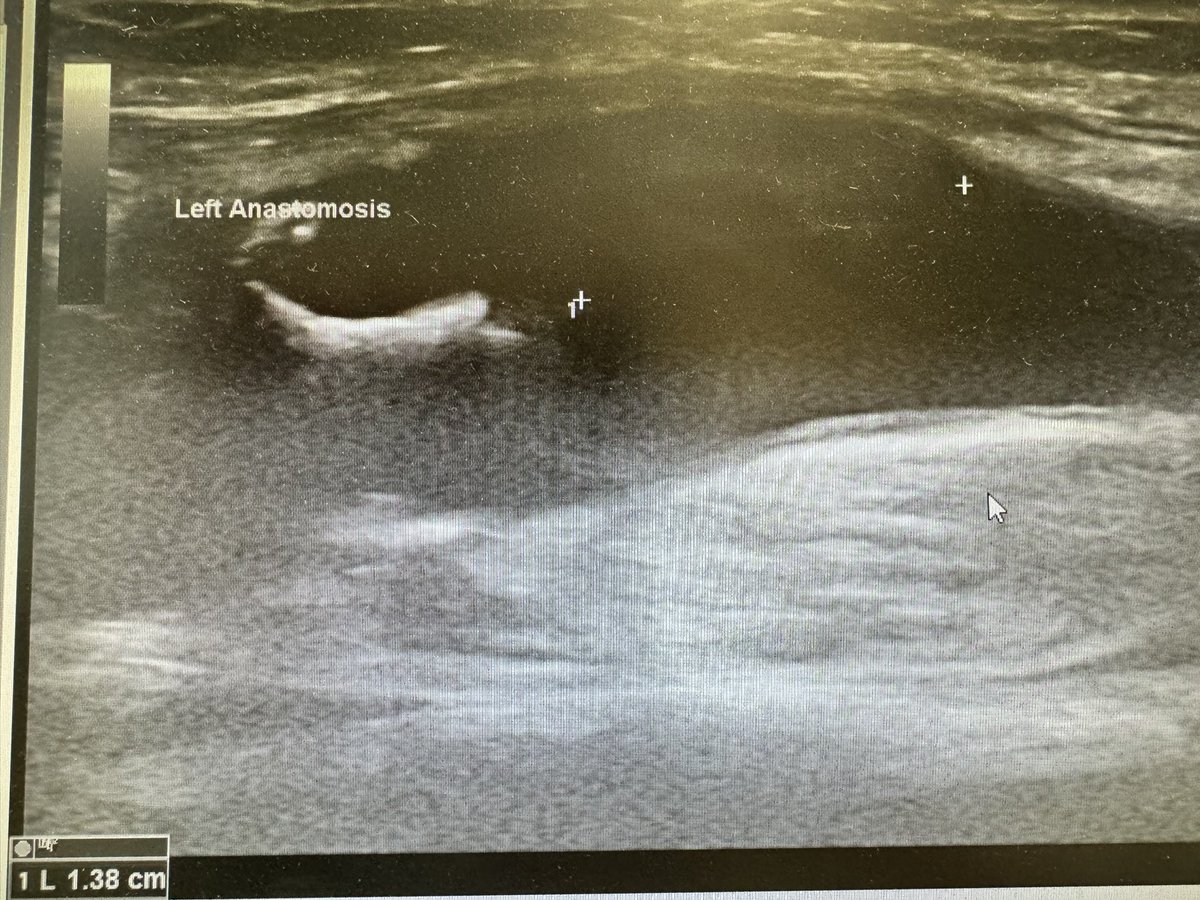 robshahverdyan's tweet photo. Occasionally, we see calcifications at the juxtaanastomotic vein segment of #AVF (typically after many years) due to local hemodynamics. This is however the first time I see calcification (not flow-limiting) of the juxtaanastomotic radial vein in a 4 years old #WavelinQ #endoAVF https://t.co/XKypVLdpiP