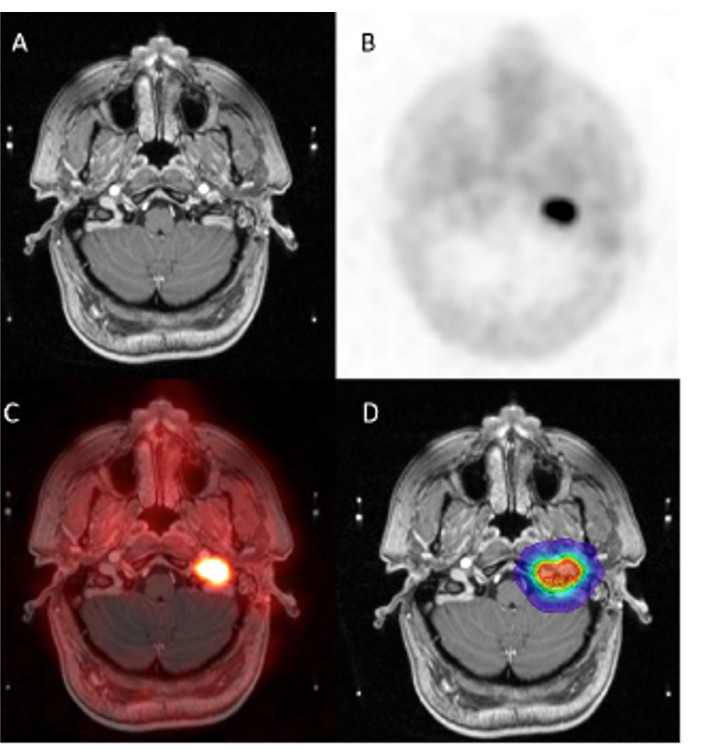PET/CT Superior to MRI for Lesion Detection in Head and Neck Paragangliomas

Read more ➡️ bit.ly/3RqGIVf
<a href="/SNM_MI/">SNMMI</a>

#RadOncNews #snmmi24 #PETCT #HNC #NucMed #HeadAndNeckCancer