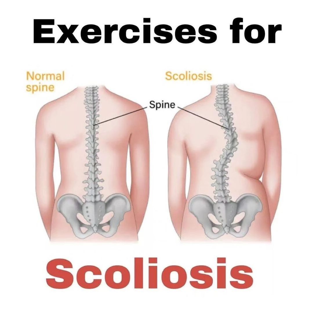 FitnessGuide0's tweet photo. Exercises for Scoliosis.... https://t.co/uIcJ3UedxT
