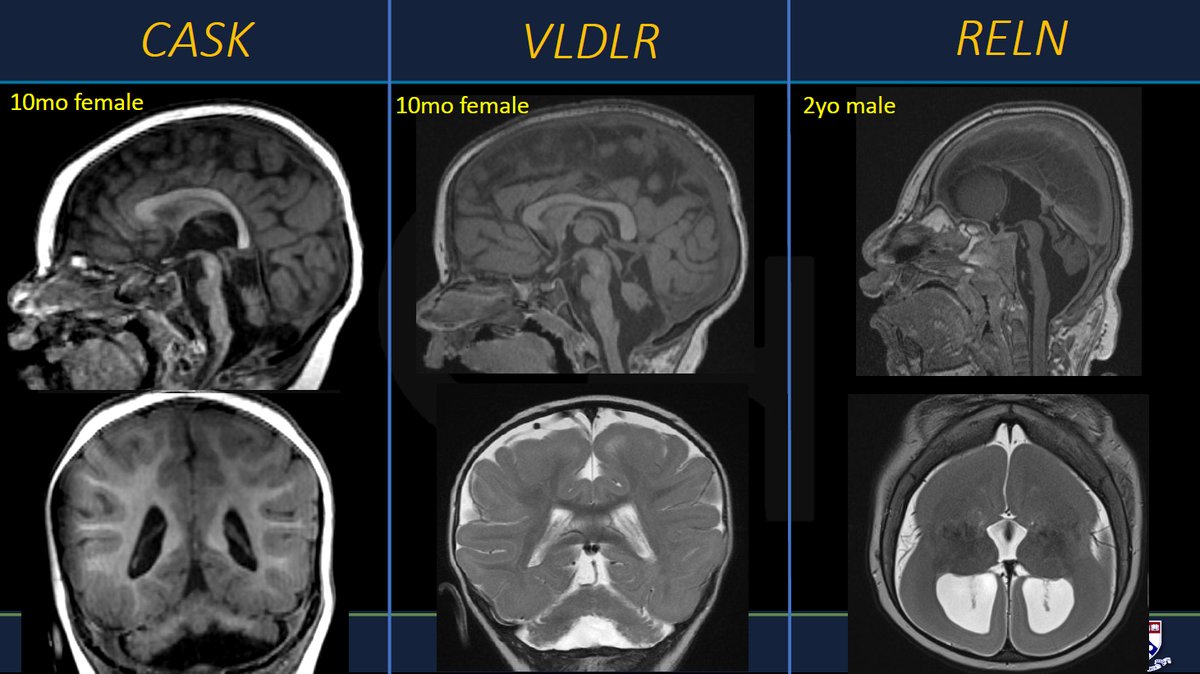 Finishing up with diffuse malformations! We can't get enough of this talk! Thank you Dr. Whitehead!