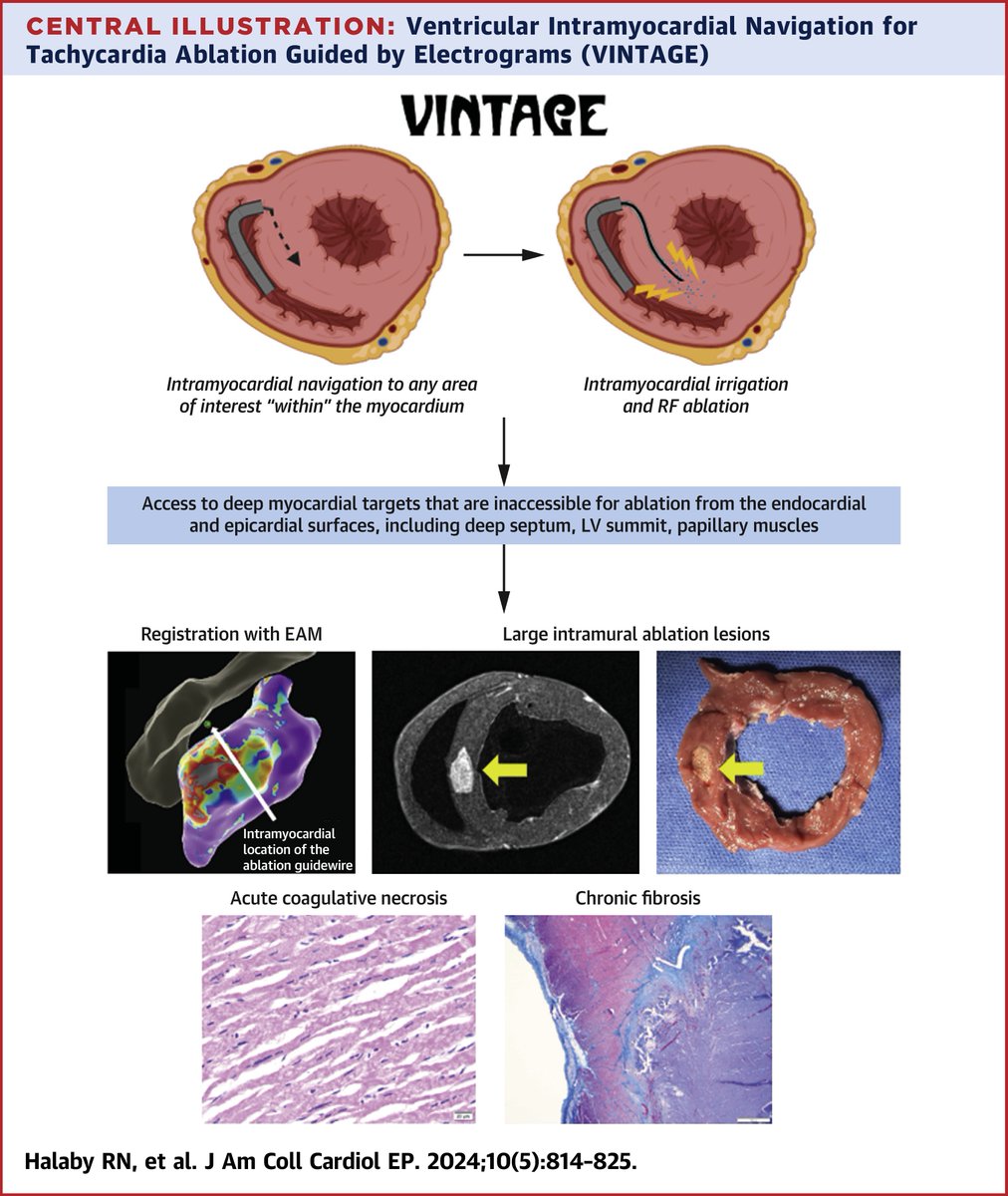 JACC Journals (@jaccjournals) on Twitter photo VINTAGE, a novel intramyocardial ablation technique, was safe & effective at creating intramural ablation lesions in targets traditionally considered inaccessible from the endocardium & epicardium, both naive & infarcted. bit.ly/4bVQGW8
#JACCCEP #epAblation <a href="/rimhalabymd/">Rim Halaby</a> VINTAGE, a novel intramyocardial ablation technique, was safe & effective at creating intramural ablation lesions in targets traditionally considered inaccessible from the endocardium & epicardium, both naive & infarcted. bit.ly/4bVQGW8
#JACCCEP #epAblation <a href="/rimhalabymd/">Rim Halaby</a>