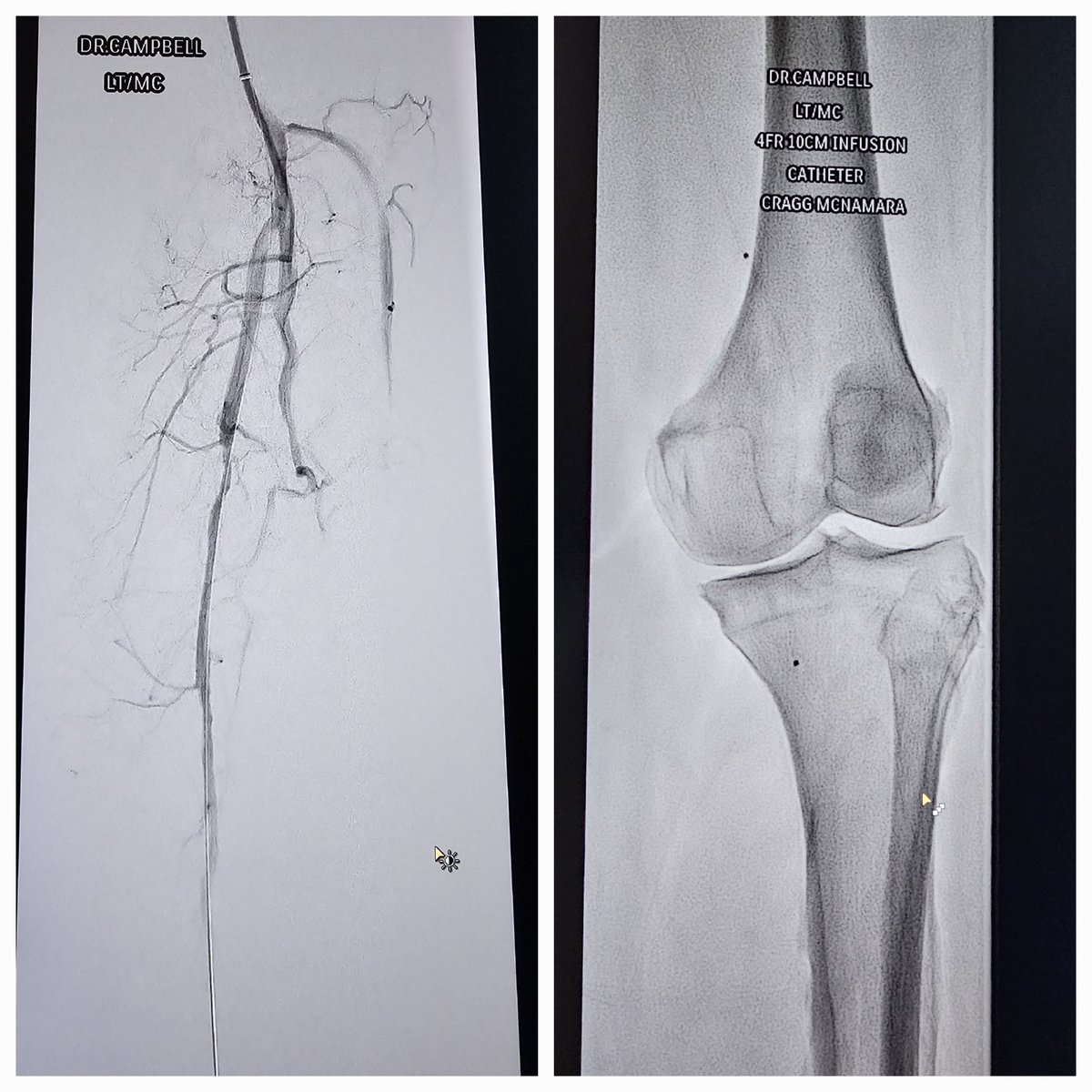 Day 1 I did Thrombectomy+ lysis @LessneVIR @rkryu @ChengaziMD @Watts_IR @baobui99 @limbsalvagedr @linemonkeymd @AaronFrittsMD @DonGarbettMD @DeepBlueDoc21 @RSP516 @TherealDoctorJ @RafaMalgor @_backtable @farkomd @VIRChicago @LakelandVascul1 @JongParkIR @doctorbiglar