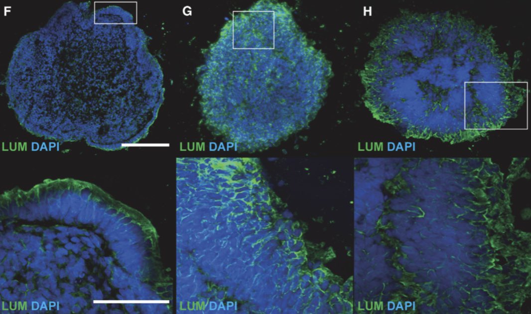 MariyaMoosajee's tweet image. Our @stemcellreports on disruption of common ocular developmental pathways in patients with #microphthalmia reveal increased extracellular matrix #ECM encapsulates the early eye with increased cell death! 

cell.com/stem-cell-repo…

👏🏼@JEintracht @PhilippaHarding @Dr__NO @UCLeye