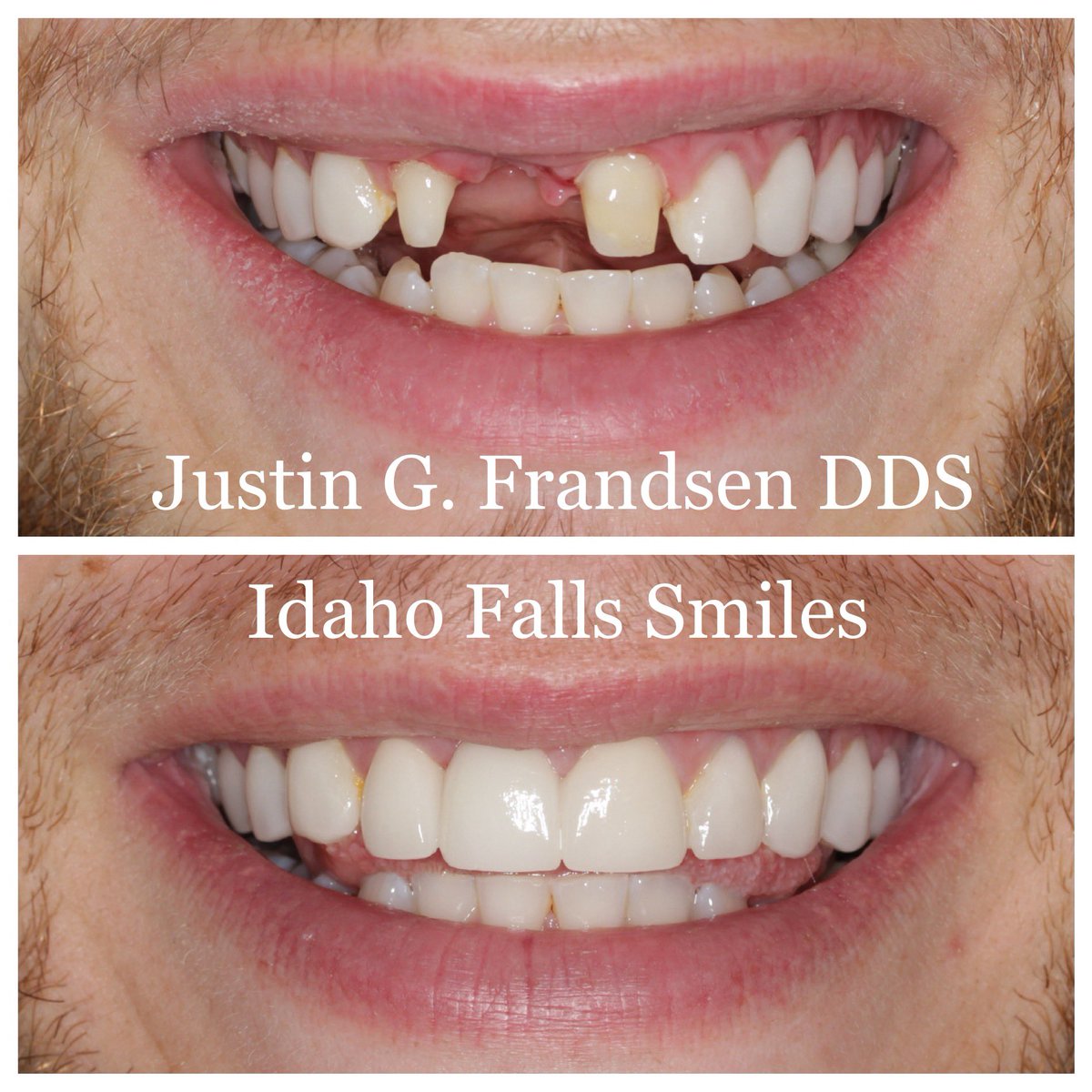FrandsenDDS's tweet photo. Cosmetic cases.  What athlete hasn’t been hit in the mouth?  We have so many athletes that come into the dentist with traumatic injuries to the mouth and teeth.  If you have a missing tooth and are self conscious about the way your smile looks, give us a call!   #IdahoFallsSmiles https://t.co/A75ey76Ljj
