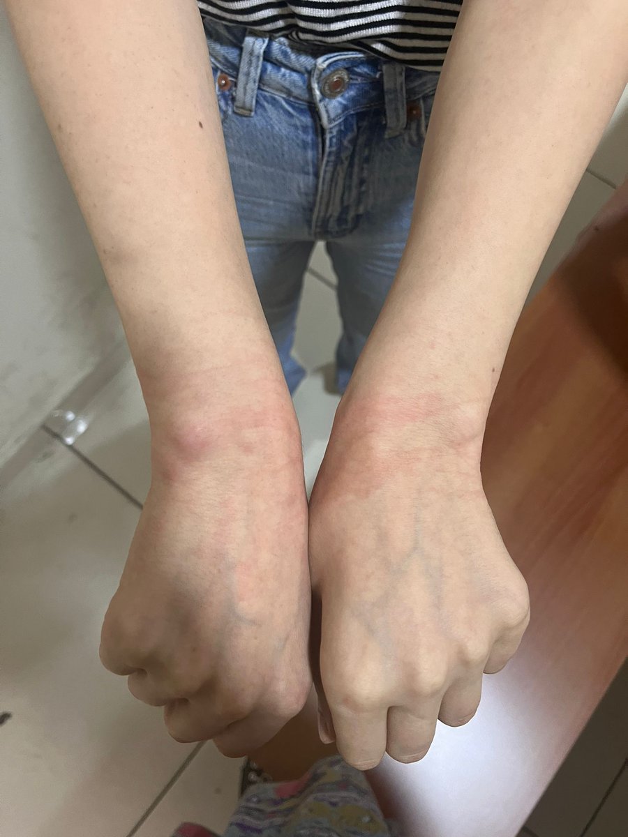 ogretmensendika's tweet photo. İstanbul | İstanbul'da gözaltına alınan öğretmenlere vicdansızca ters kelepçe yapıldı. Kimi arkdaşlarımız darp edildi; kollarında, çeşitli yerlerinde yara izleri ve morluklar oluştu.
Ülkede öğretmenleri düşürdükleri durum bu. 

Öğretmenin saygınlığını, @tcmeb ve patronlar el ele verip iki paralık ettiniz ama halkın Sendikası ve o Sendikanın öğretmenleri, öğretmenlik mesleğini de eğitimi de bu çürümüşlüğe teslim etmeyecek! #ÖğretmenlerGözaltında #EğitimNöbetindeyiz