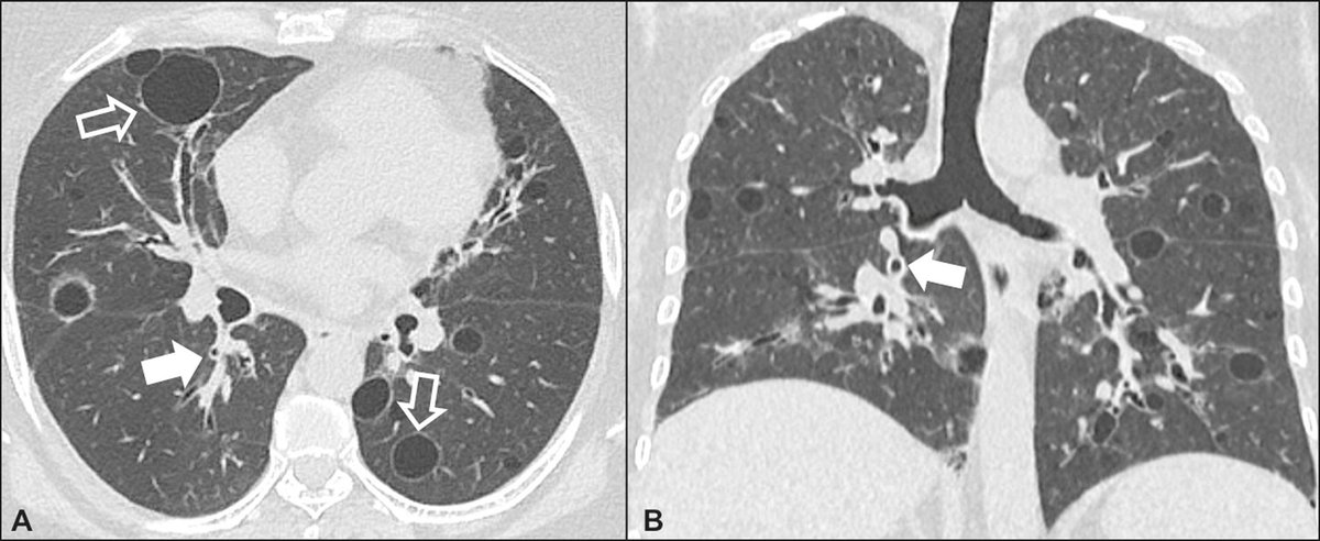 Lymphoid interstitial pneumonia (LIP) Benign polyclonal proliferation of B/T cells in the 🫁 Causes: ⭐️Rheum: Sjogrens (25%), RA, SLE ⭐️ID: HIV, HTLV-1 ⭐️ 💊: phenytoin ⭐️Idiopathic (<20%) CT ⭐️ Cysts (~75%): peribronchovascular ⭐️ GGOs: lower lobe ⭐️ Centrilobular nodules