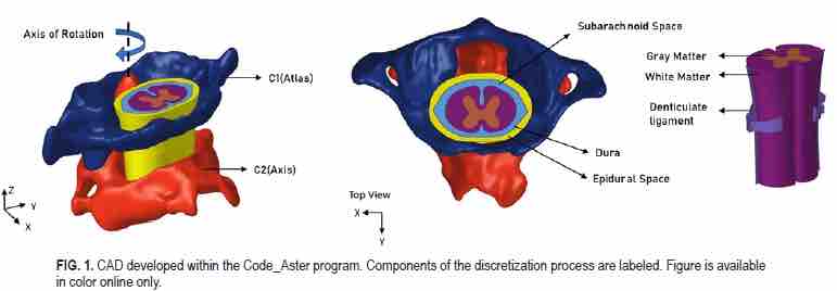 #OnlineFirst: C1–2 hypermobility and its impact on the spinal cord: a finite element analysis. thejns.org/spine/view/jou…