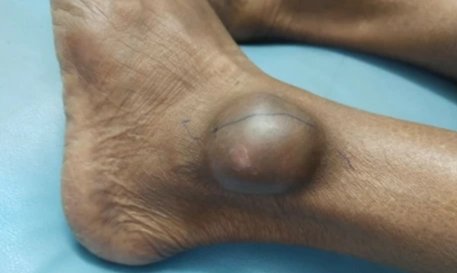 Inoniaimuin's tweet photo. General Surgery

Case description

Surgical case: a 65 years old woman presented with a mass on the lateral malleolus of left leg. The size is spherical and painless. Margin is regular and it is movable. Not attached to bone or tendon. Most common diagnosis is Dermoid Cyst. https://t.co/oamiNJux2a