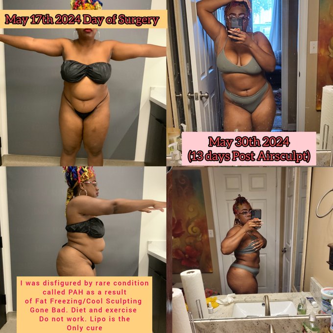 Cool Sculpting Fucked me all the way up!  I was disfigured. It was awful. Thank Source for @AirSculpt Shit<a href="/tag/coolsculpting"class="tags"><span>#coolsculpting</span></a><a href="/tag/fatfreezing"class="tags"><span>#fatfreezing</span></a><a href="/tag/pah"class="tags"><span>#pah</span></a><a href="/tag/airsculpt"class="tags"><span>#airsculpt</span></a>